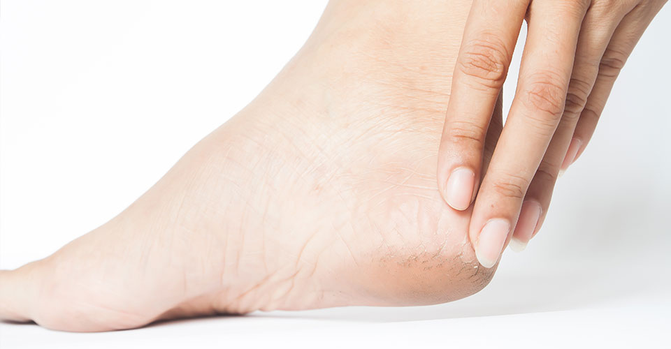 Dolore al piede: cause, sintomi e rimedi naturali